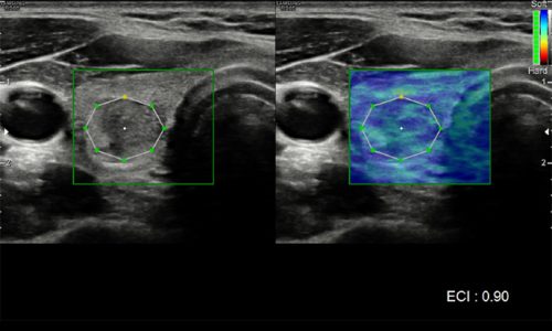 ecografia, ecocolordoppler